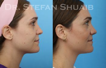 female patient before and after Rhinoplasty