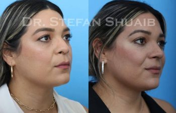 female patient before and after Rhinoplasty