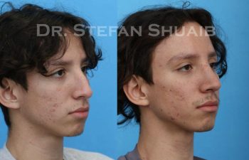 male patient before and after Rhinoplasty