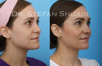 female patient before and after Rhinoplasty