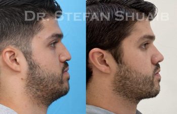 male patient before and after Rhinoplasty