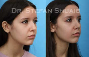 female patient before and after Rhinoplasty