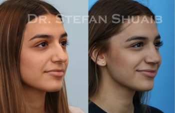 female patient before and after Rhinoplasty