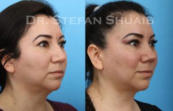 female patient before and after Rhinoplasty