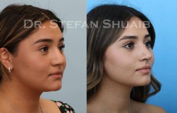 female patient before and after Rhinoplasty