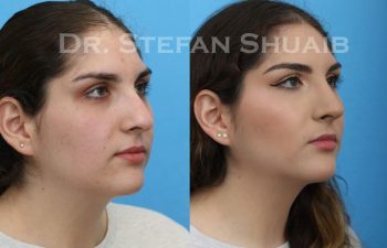 female patient before and after Rhinoplasty