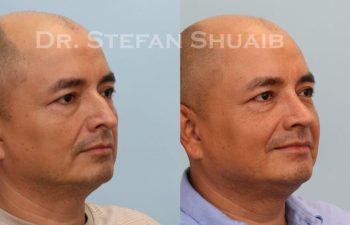 male patient before and after Rhinoplasty