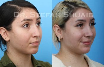 female patient before and after Rhinoplasty