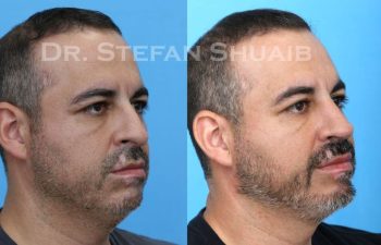 male patient before and after Rhinoplasty