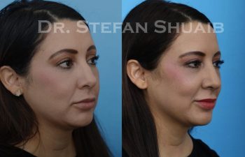 female patient before and after Rhinoplasty