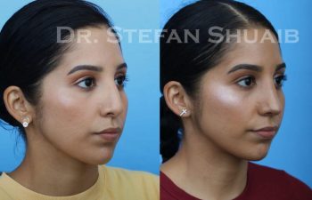 female patient before and after Rhinoplasty