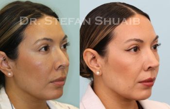 female patient before and after Rhinoplasty