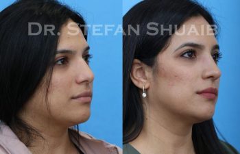 female patient before and after Rhinoplasty