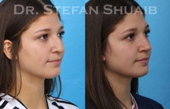 female patient before and after Rhinoplasty