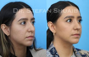 female patient before and after Rhinoplasty