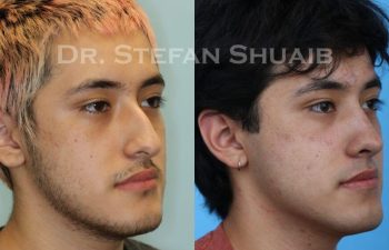 male patient before and after Rhinoplasty