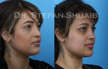 female patient before and after Rhinoplasty