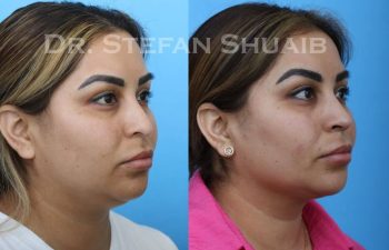 female patient before and after Rhinoplasty