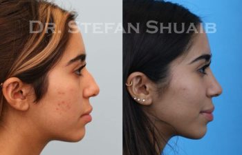 female patient before and after Rhinoplasty