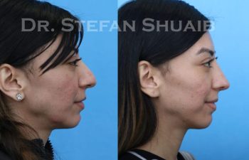 female patient before and after Rhinoplasty