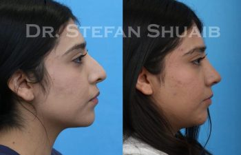 female patient before and after Rhinoplasty