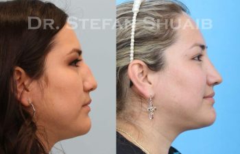 female patient before and after Rhinoplasty