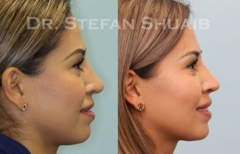 female patient before and after Rhinoplasty