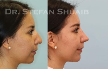 female patient before and after Rhinoplasty