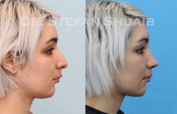 female patient before and after Rhinoplasty