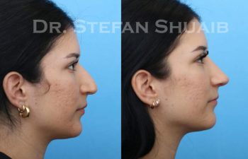 female patient before and after Rhinoplasty