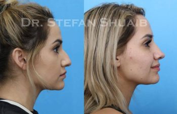 female patient before and after Rhinoplasty