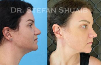 female patient before and after revision rhinoplasty