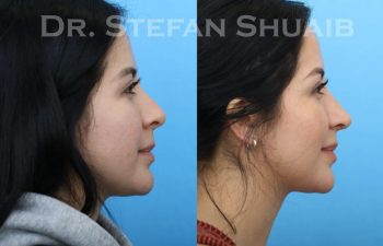 female patient before and after Rhinoplasty