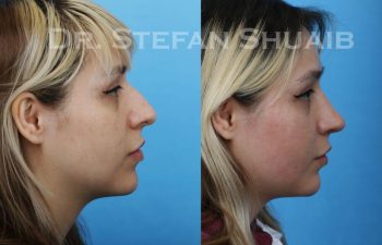 female patient before and after Rhinoplasty