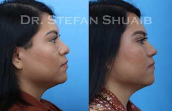 female patient before and after Rhinoplasty