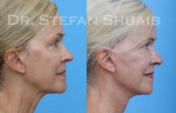 female patient before and after Facial Rejuvenation