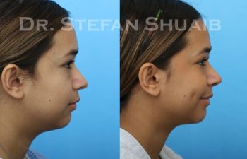 female patient before and after revision rhinoplasty