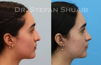 female patient before and after Rhinoplasty