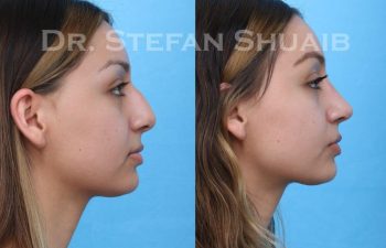 female patient before and after Rhinoplasty