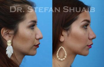 female patient before and after Rhinoplasty