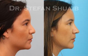 female patient before and after Rhinoplasty