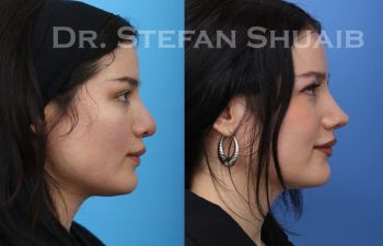 female patient before and after revision rhinoplasty