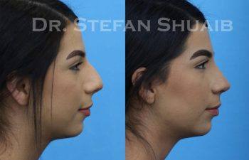 female patient before and after Rhinoplasty