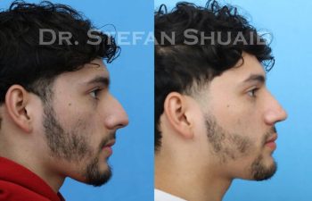 male patient before and after Rhinoplasty