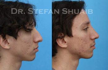 male patient before and after Rhinoplasty