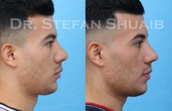 male patient before and after Rhinoplasty