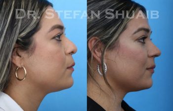 female patient before and after Rhinoplasty