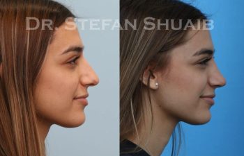 female patient before and after Rhinoplasty