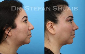 female patient before and after Rhinoplasty