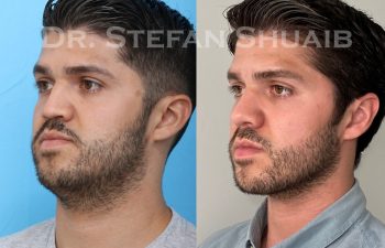 male patient before and after Rhinoplasty